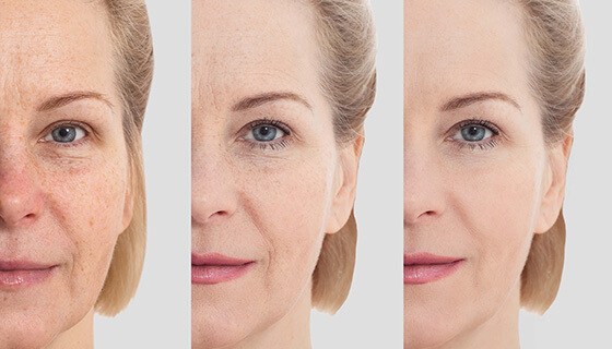 Close-up image of a woman’s face showing before-and-after cosmetic treatment.