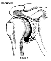 Diagram showing a reduced shoulder, where the humeral head is back in place