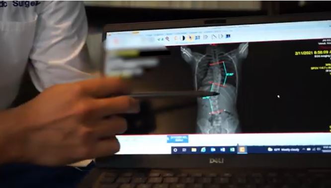 Dysport for Scoliosis diagram